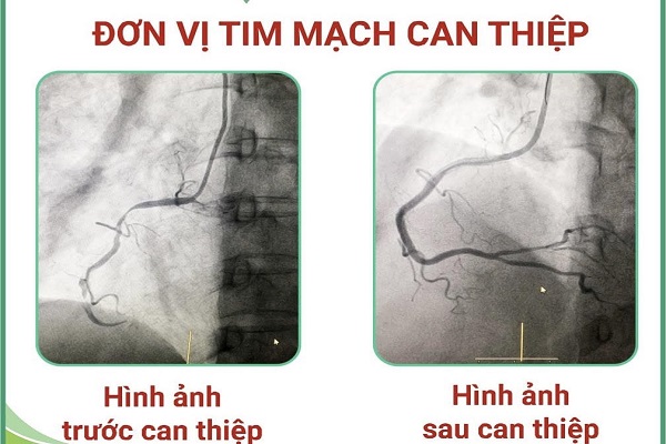 Hình ảnh trước và sau can thiệp tim mạch tại Bệnh viện Đa khoa Hợp Lực